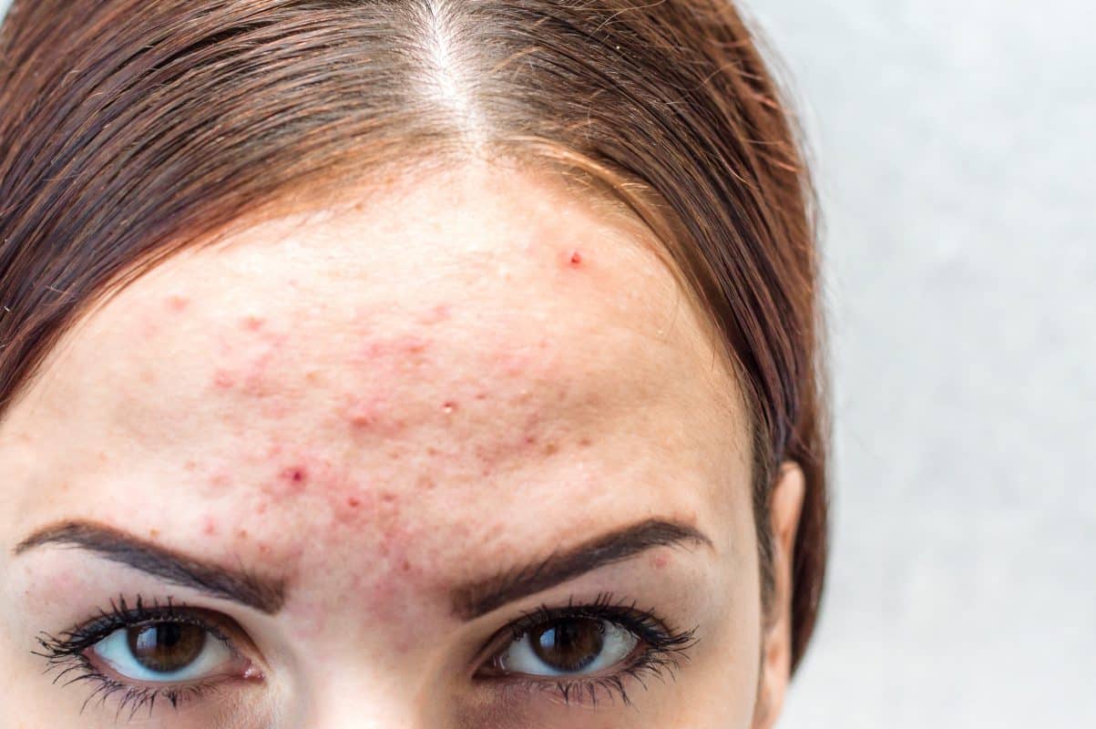 Skin-Care Products for Acne-Prone Skin 2 shutterstock 1130318858 min