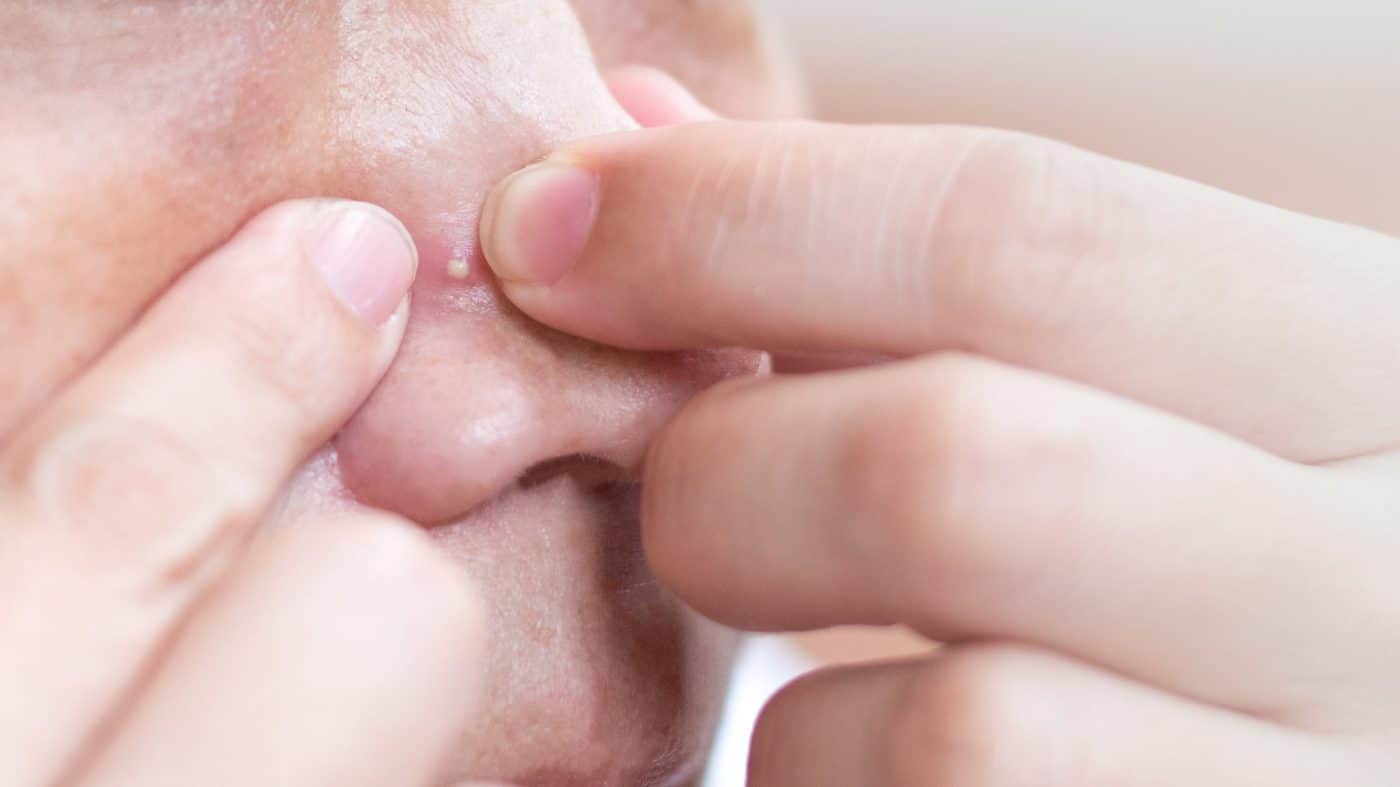 Skin-Care Products for Acne-Prone Skin 5 shutterstock 1710065092 min
