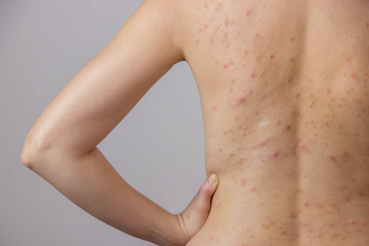 Skin-Care Products for Acne-Prone Skin 4 shutterstock 416959045 min