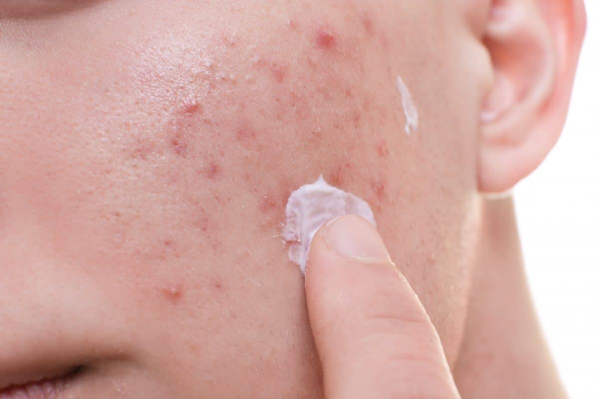 Skin-Care Products for Acne-Prone Skin 1 shutterstock 579880087 min